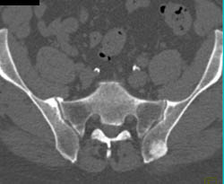 Osteosarcoma Iliac Bone - CTisus CT Scan