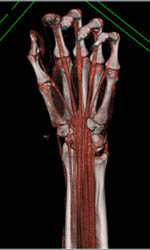 Nice Tendons in 3D - CTisus CT Scan