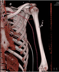 CTA Axilla S/P Trauma With Nice Visualization of Axillary and Brachial Arteries - CTisus CT Scan