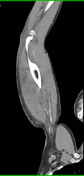 CTA Arm Without Bleed - CTisus CT Scan