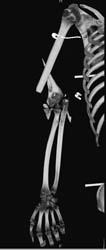 Fracture Humerus With Fragmentation W/o Vascular Injury - CTisus CT Scan