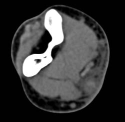 Cellulitis With Venous Thrombosis - CTisus CT Scan