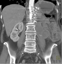 Mass in Paraspinal Area Without Bleed - CTisus CT Scan