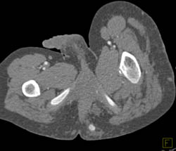 GSW Pelvis With Bleed - CTisus CT Scan