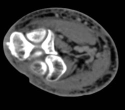 Cellulitis - CTisus CT Scan