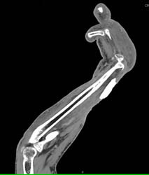 Cellulitis Fluid - CTisus CT Scan