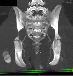 Pelvic Fracture With Bleed - CTisus CT Scan