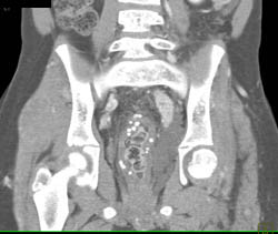 Pelvic Fluid - CTisus CT Scan