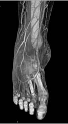 CTA Foot With Chronic Inflammation With Various Renderings - CTisus CT Scan