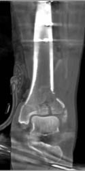 Tibial Fracture and Open Wound - CTisus CT Scan