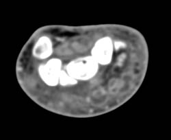 Cellulitis - CTisus CT Scan