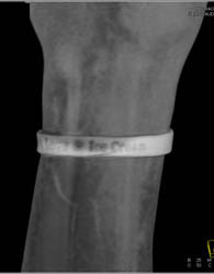 Cellulitis - CTisus CT Scan