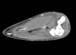 Abscess With Vascular Changes - CTisus CT Scan