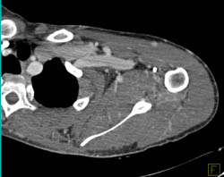 Arteriovenous Malformation (AVM) Shoulder With Embolization - CTisus CT Scan