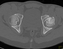 Avascular Necrosis (AVN) With Fracture - CTisus CT Scan