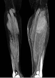 Calf Hematoma - CTisus CT Scan