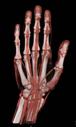 Cellulitis - CTisus CT Scan