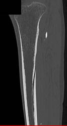 Vascular Channel - CTisus CT Scan