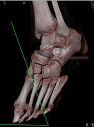 Lisfranc Fracture - CTisus CT Scan