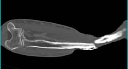 Non Union Fracture - CTisus CT Scan