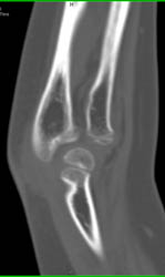 Elbow S/P Reduction - CTisus CT Scan