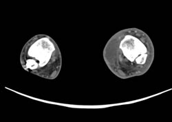 Abscess in Calf - CTisus CT Scan