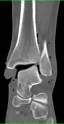 Disrupted Ankle Joint - CTisus CT Scan