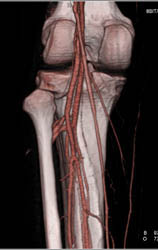 Normal Vessel Trifurcation - CTisus CT Scan