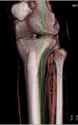 CTA at Trifurcation - CTisus CT Scan