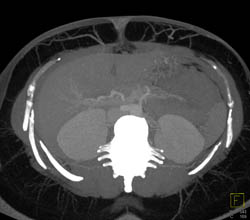 DIEP Flap Planning - CTisus CT Scan