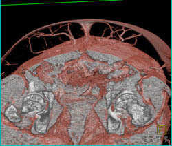 DIEP Flap Planning - CTisus CT Scan