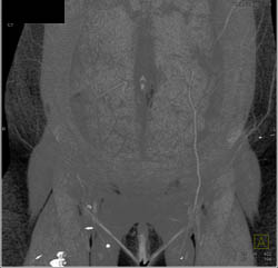 DIEP Flap Planning - CTisus CT Scan