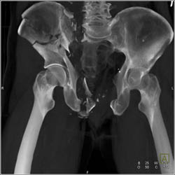 Complex Pelvic Fractures With SI Joint Widening and Diastasis of Symphysis - CTisus CT Scan