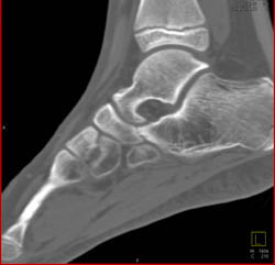 Calcaneal Coalition - CTisus CT Scan