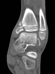 Tibial and Talar Fractures - CTisus CT Scan