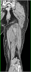 Thigh Hematoma With Auto-bone Removal - CTisus CT Scan