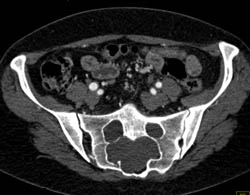 Dural Ectasia in Marfan Syndrome - CTisus CT Scan