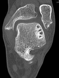 Cyst in Talus and Calcaneal Spurs - CTisus CT Scan