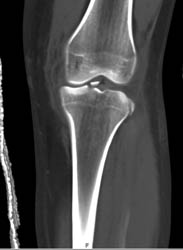 Tibial Plateau Fracture - CTisus CT Scan