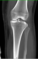 Tibial Plateau Fracture - CTisus CT Scan