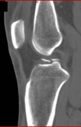 Tibial Plateau Fracture - CTisus CT Scan