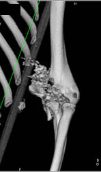 GSW to Elbow With Comminuted Fractures - CTisus CT Scan