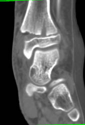 Tibial Fracture With Injury to Epiphysis. Fibular Fracture Also Seen - CTisus CT Scan