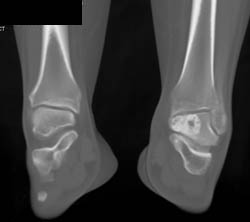 Benign Cortical Lesion Talus - CTisus CT Scan