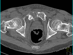 Osteomyelitis of Symphysis With Abscess - CTisus CT Scan