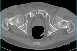 Infection of Symphasis Pubis - CTisus CT Scan