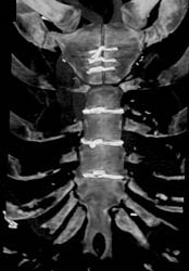 Post Medial Sternotomy Shows Sternal Wires - CTisus CT Scan