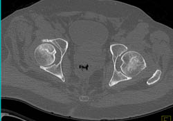 Avascular Necrosis (AVN) Femurs - CTisus CT Scan