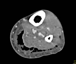 Necrotizing Fasciitis - CTisus CT Scan