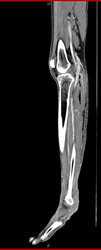 Necrotizing Fasciitis - CTisus CT Scan